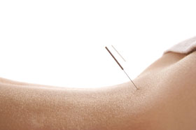 Akupunktur - Sanfte Akupunktur